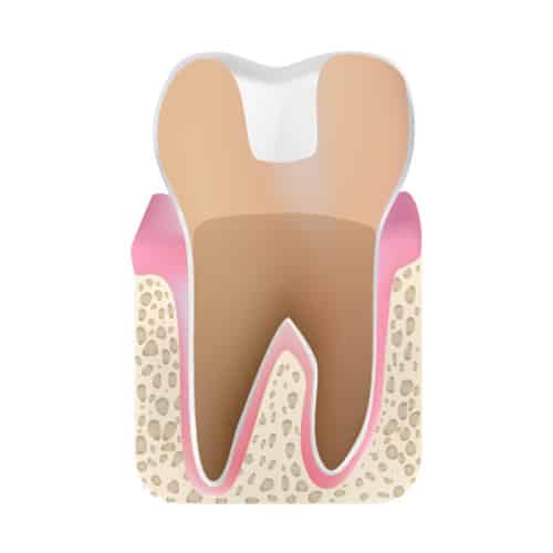 Onlays 4 Tooth With Dental Onlay