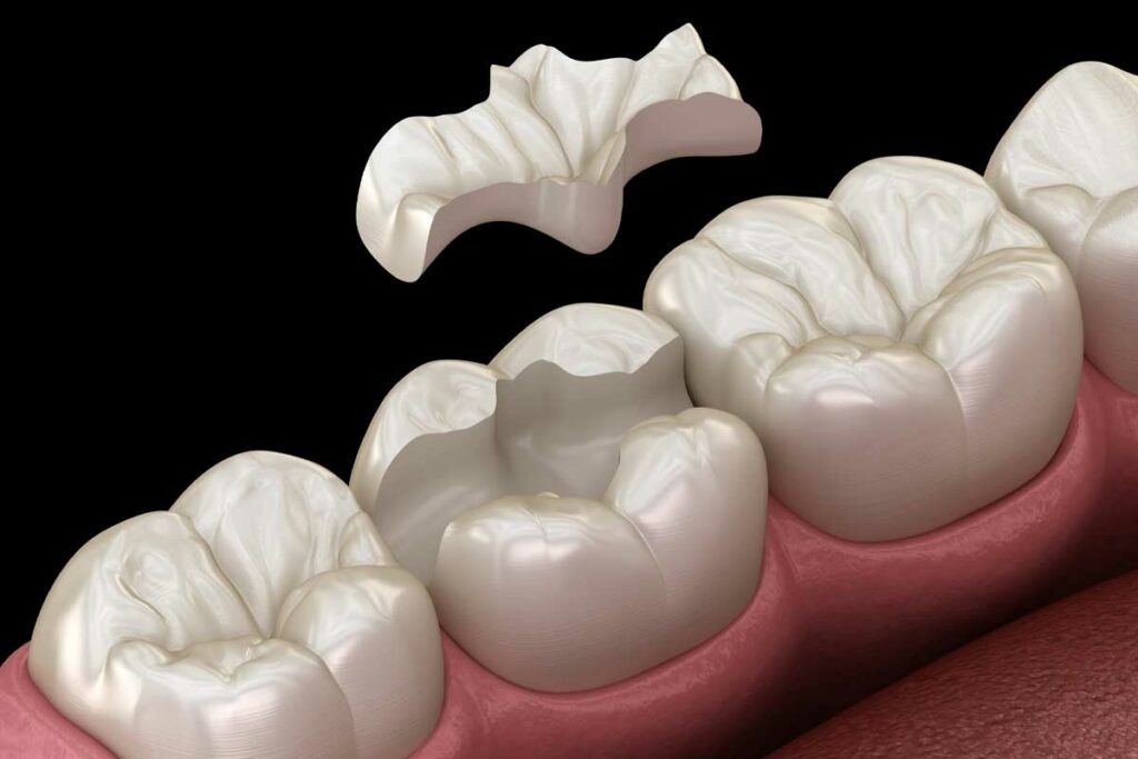 Inlays 1 Tooth Inlay