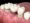 Dental Bridge Being Placed On Abutment Teeth