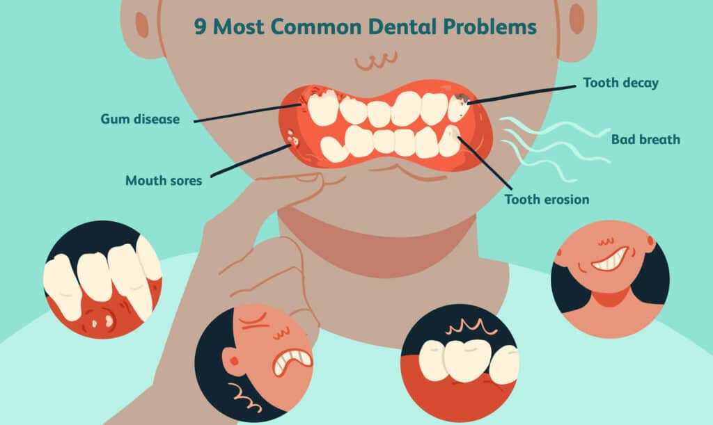 Can Bad Teeth Cause Breast Cancer