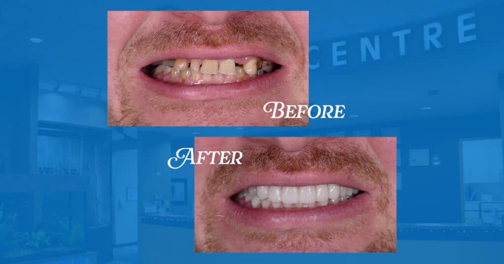Dental Crowns Edmonton